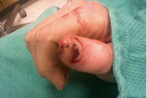 Jen's thumb